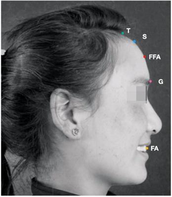 Analysis of maxillary teeth and soft tissue profiles among Tibetan and Han Chinese females with facial symmetry for orthodontic treatment planning
